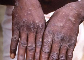 Bakan Koca’dan ‘maymun çiçeği’ açıklaması