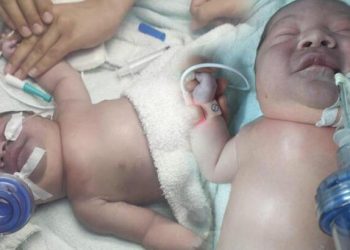 Yeni doğan bebeğin köprücük kemiği kırıldı, bedeni mosmor oldu