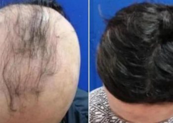 6 ay sonra yine saçları çıktı! ‘Bu ilaç umut olabilir’