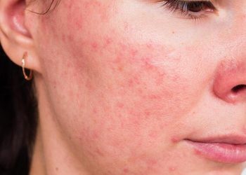 Cep telefonu dermatiti gitgide artıyor! Çok değerli ‘nikel’ uyarısı