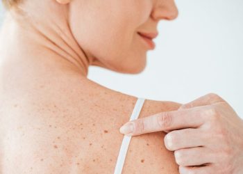 Kollardaki çıkan sivilcelerden nasıl kurtulabilirim?