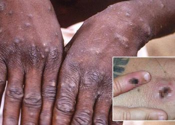 Maymun çiçeğinde 28 günlük karantina! Bilim Heyeti üyesi duyurdu