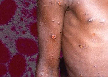 Maymun çiçeğinde salgın ve mutasyon beklenmiyor! Kritik 3 yıl ayrıntısı