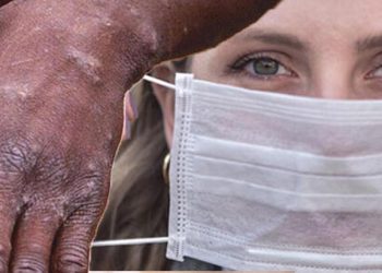 Uzmanı uyardı! 42 yaş altı maymun çiçeği enfeksiyonuna açık